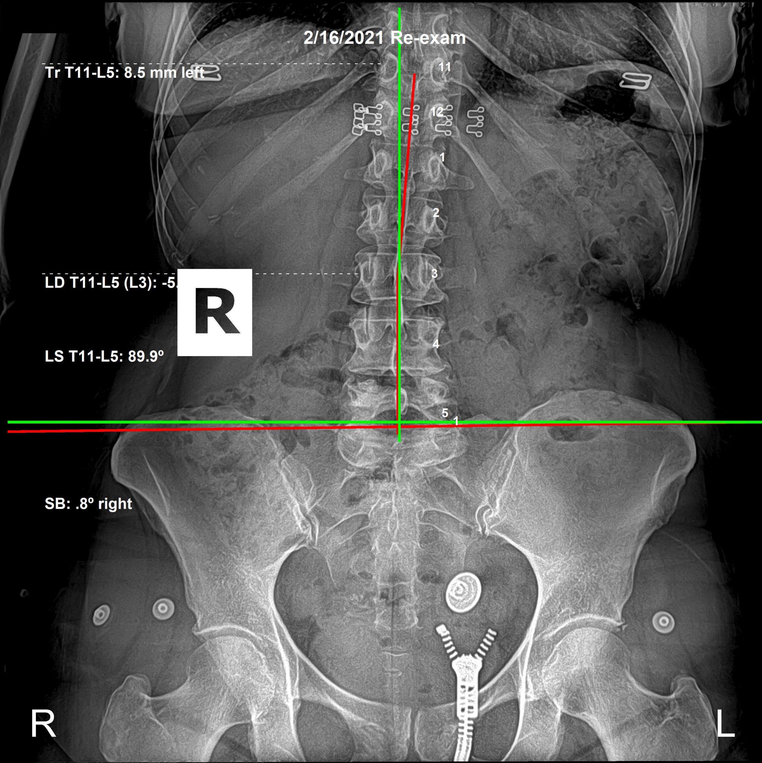 Spinal Correction Spotlight: Case 17