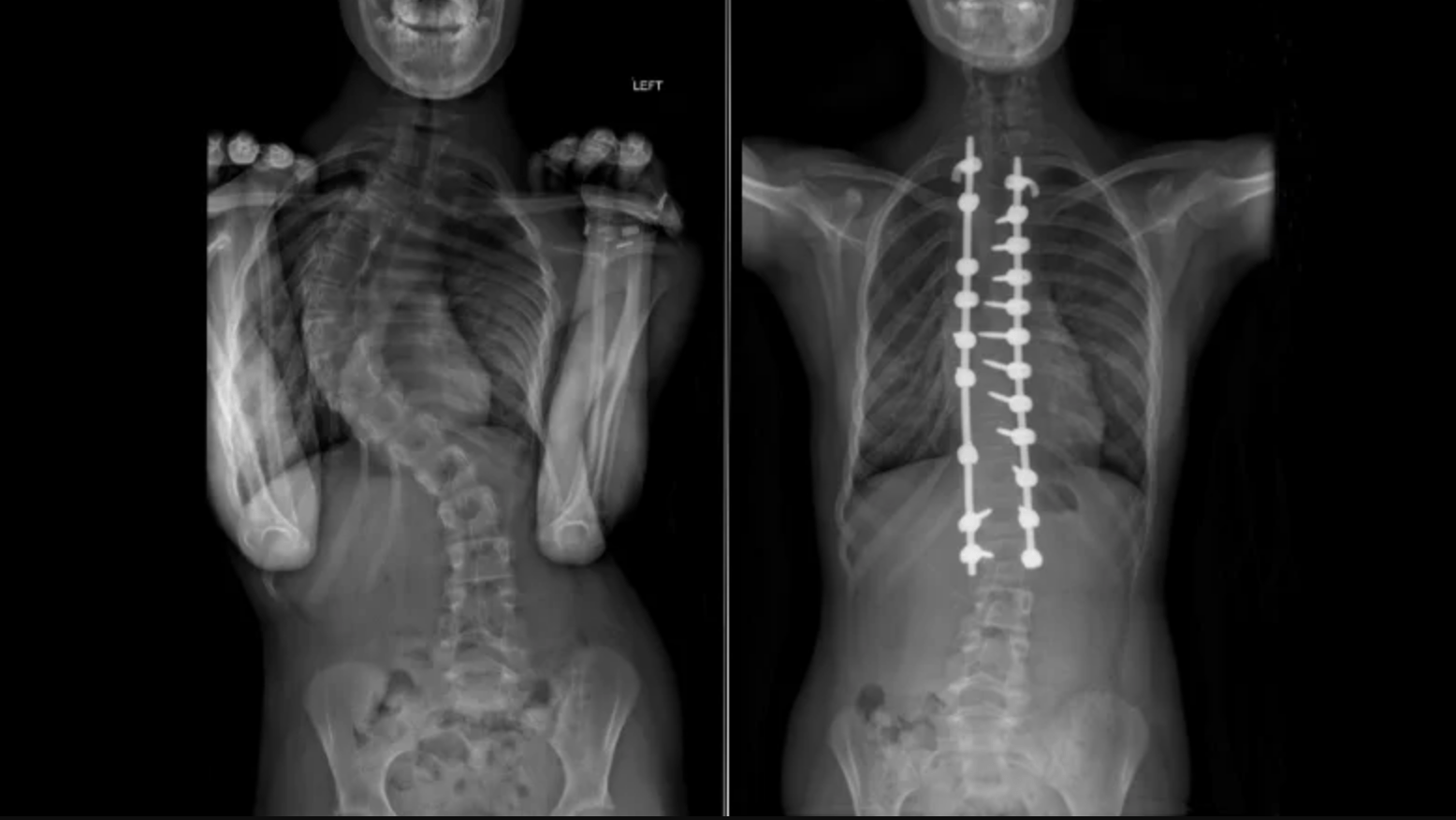 Can Chiropractic Help Scoliosis - Rochet Family Chiropractic